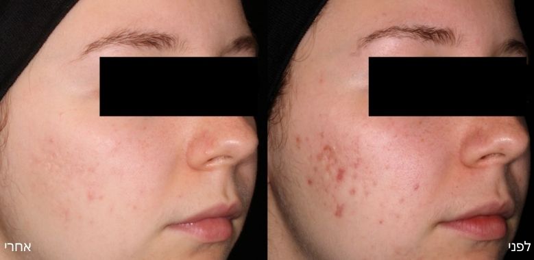 before after 1