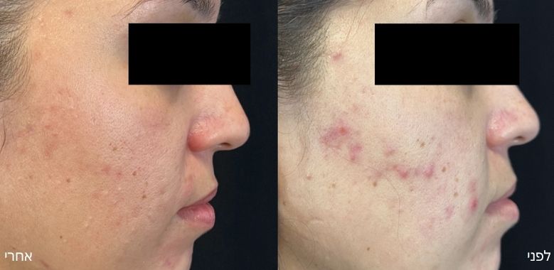 before after 4