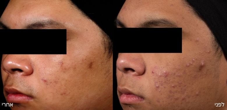 before after 8