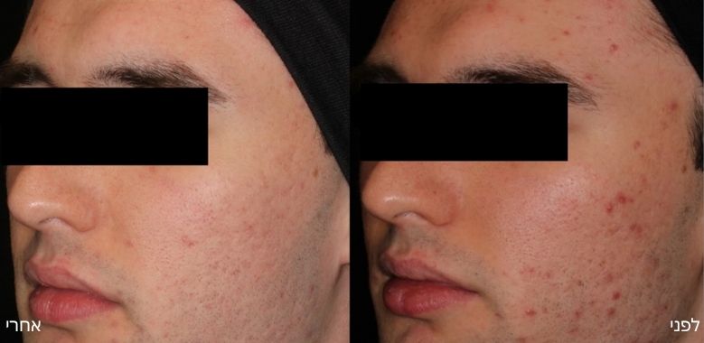 before after 9